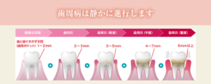 歯周病治療｜いしはら歯科クリニック