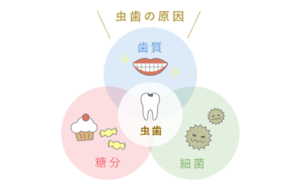むし歯治療｜いしはら歯科クリニック