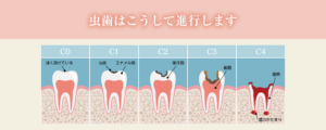 むし歯治療｜いしはら歯科クリニック