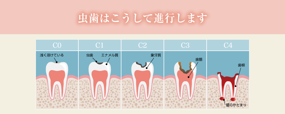 むし歯治療｜いしはら歯科クリニック